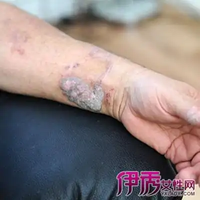 【血毒引起的皮肤病图片】【图】血毒引起的皮肤病