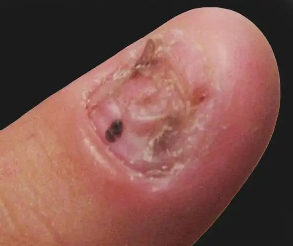 咬甲癖可能与遗传有关,发病部位在皮肤,好发于儿童或者青少年