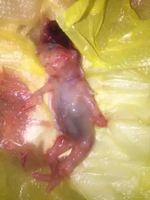 一头胎孕妇产检发现后药物流产,13周胎儿