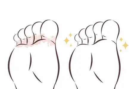 足部真菌图片-足部真菌素材-足部真菌插画-摄图新视界