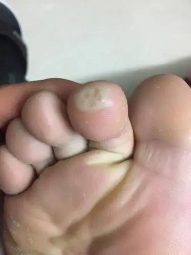 脚趾里面透明,按压疼痛,外皮会变硬成死皮,剪掉自然恢复又变死皮.