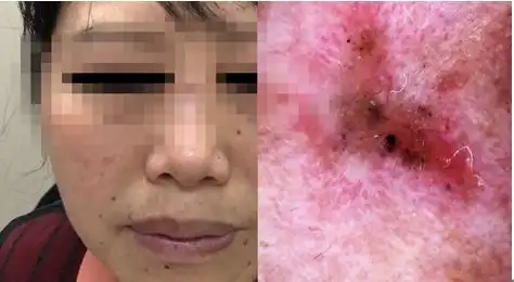 为进一步看清细微结构,医生用皮肤镜进一步证实心里的猜想,高度怀疑李