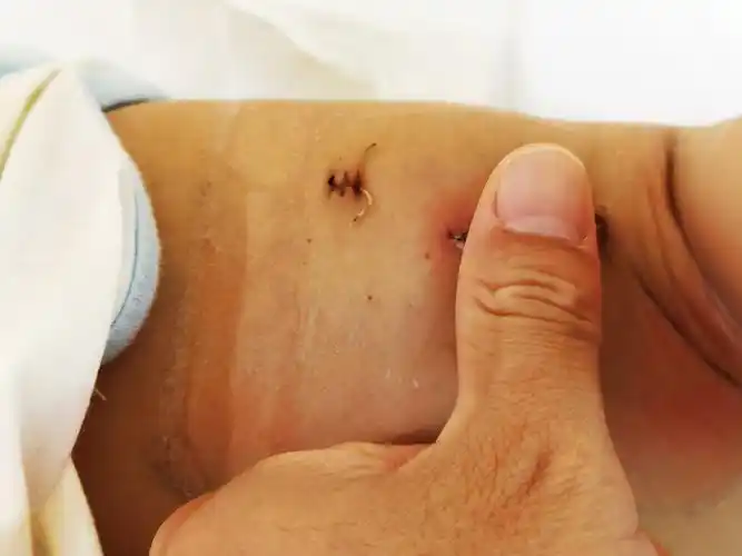 室间隔缺损微创手术 - 好大夫在线