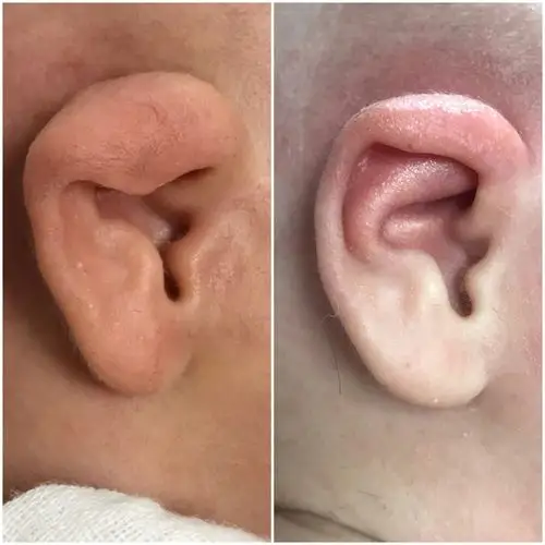 耳形态畸形及治疗效果