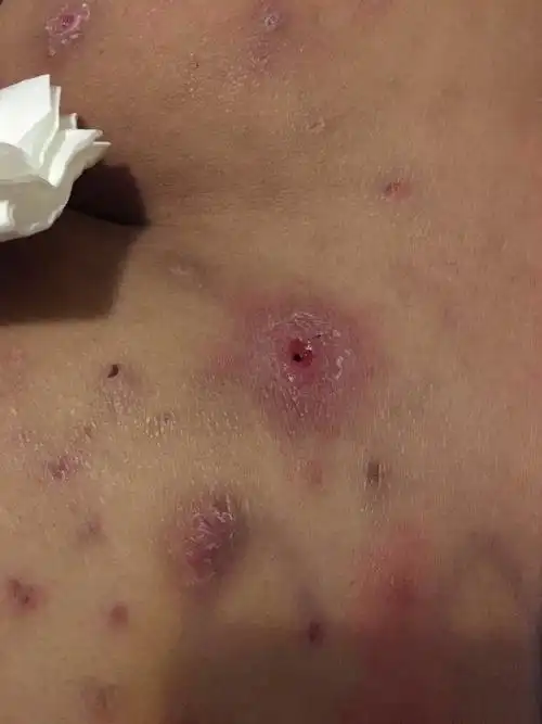 屁股长了好多年的痘痘是毛囊炎吗.