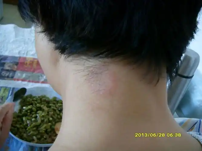 我脖子上这是什么皮肤病吗