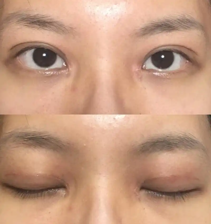 全切双眼皮两个月整