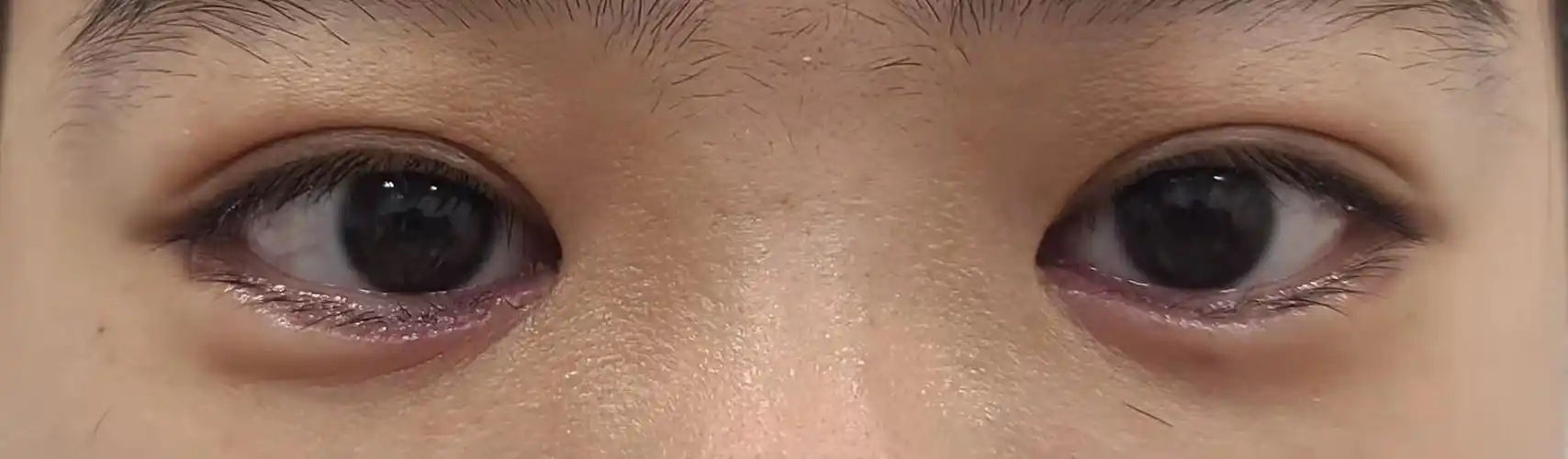 儿童,青少年下睑内翻治疗_睑内翻_睑内翻治疗方式 - 好大夫在线