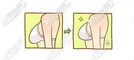 胸下垂松弛手术多少钱能矫正提升收费按乳房下垂程度