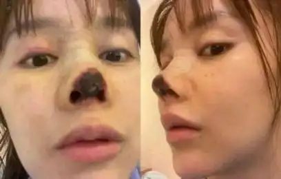 演员高溜称,2020年10月份她通过朋友介绍在一家医院咨询了鼻子整形的