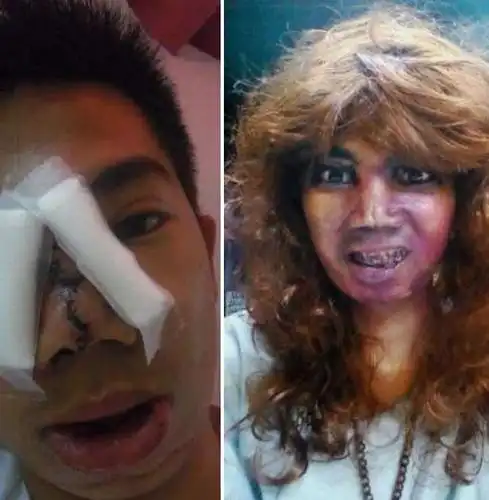 菲男模特去整形鼻子被填充密封剂混合物后毁容