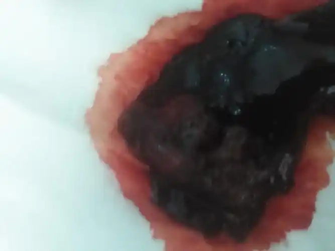 本人怀孕三个月左右自然流产,流产时间是八月三号,流了五天少量的血就