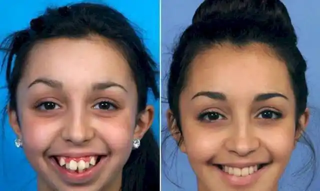 2年牙齿矫正经历分享龅牙变整齐了脸型却发生了这些变化