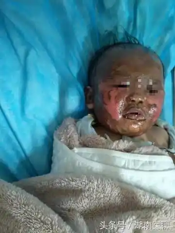 烫伤原因多为家长疏于看护,小孩不小心碰翻水杯,汤碗,热水瓶,    展开