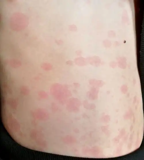 药物过敏或疱疹病毒感染有关,成人则要排除红斑狼疮等风湿免疫性疾病