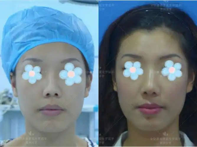 罗延平案例分享驼峰鼻矫正