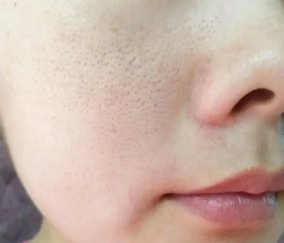 女生脸上毛孔粗大怎么办?