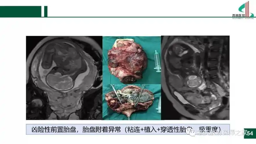 凶险性前置胎盘:影响,病理与临床