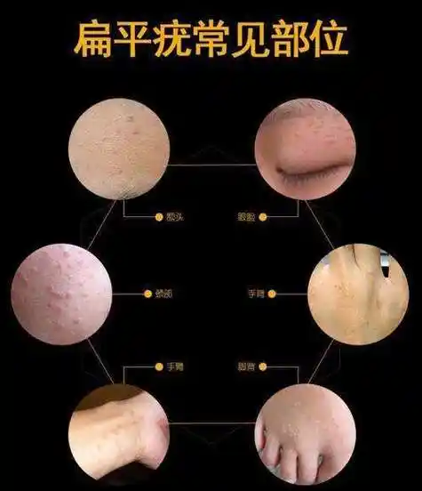 第一次长扁平疣武汉太医堂中医院一分钟带你了解扁平疣及解决方法