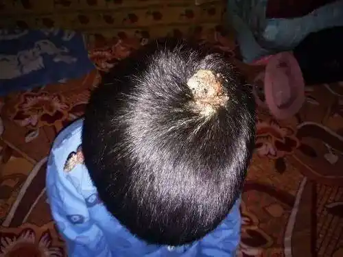 海原13岁美丽女孩患病变鬼脸头部生蛆父亲绝望放弃治疗命悬一线