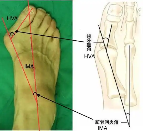双足拇外翻畸形正常双足