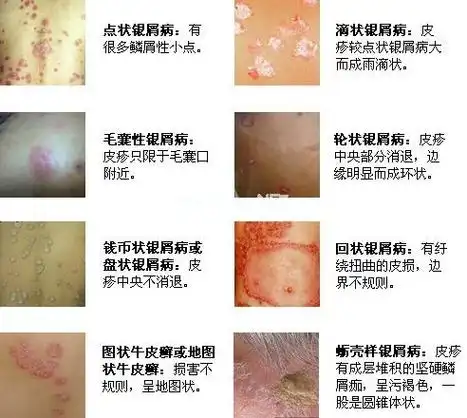 牛皮廯症状图_广州肤康皮肤病医院,广州牛皮癣专治医院,广州最好的