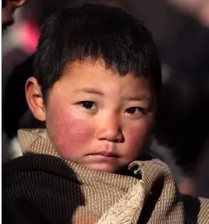 为什么会有高原红(红血丝)这种反应