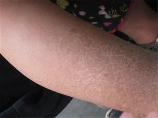 鱼鳞病初期图片 (68)