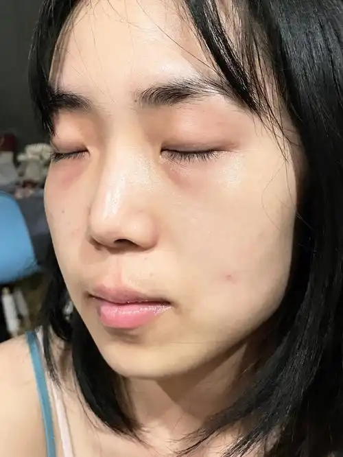 26岁原相机真实皮肤状态第35天