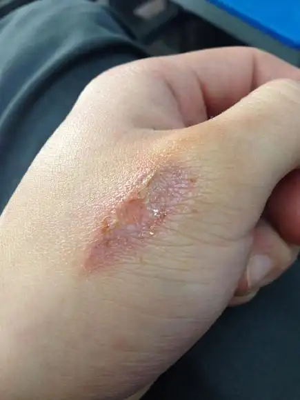 问题:【烫伤】手背与手踝处二度烫伤