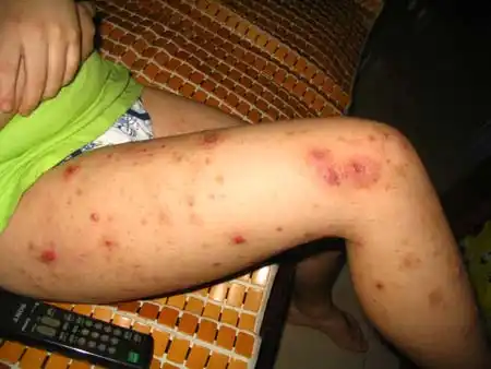 温州男孩得怪病皮肤奇痒7年不愈(图)