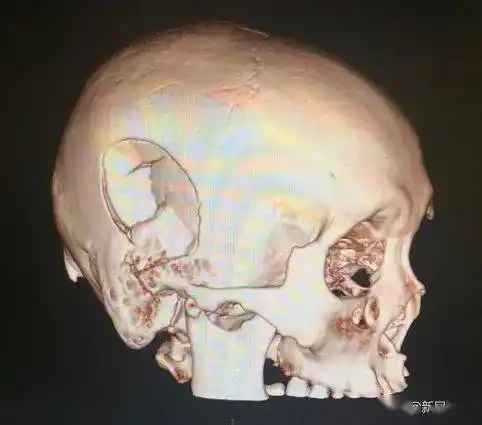 良医| 被打马赛克的这种外伤,仁济颅脑创伤团队发表重磅论文