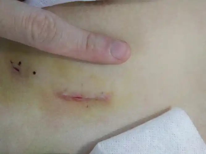 室间隔缺损封堵手术切口(术后第三天,只有3cm切口,快速出院) - 好大夫