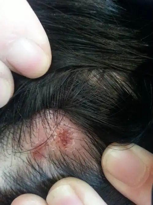 头皮上长了一个疮,溃烂了就成了这样,该怎么做