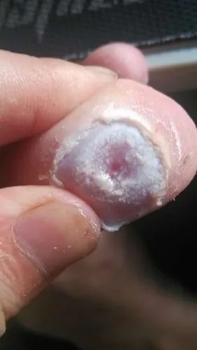 今天早晨鸡眼上面的硬肉都拔掉了.就成这样了,我想问问这样是好了吗