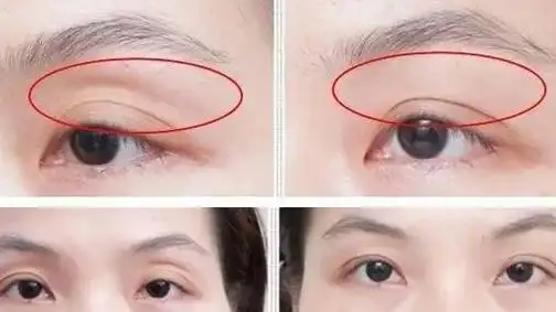 眼窝凹陷最佳解决办法?脂肪填充眼窝风险大不大?