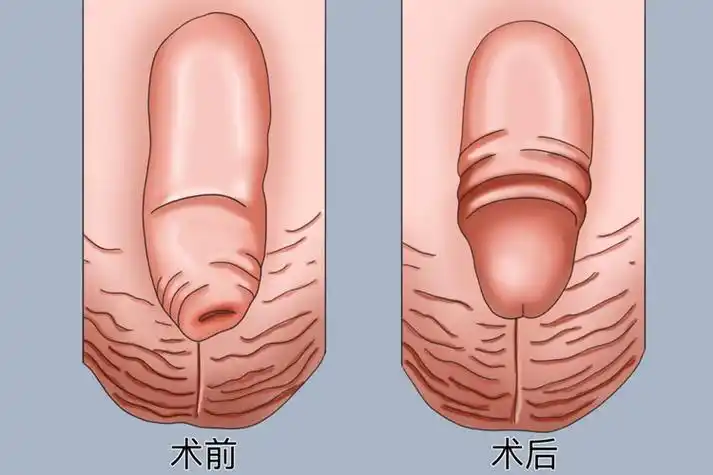 需要进行包皮环切手术防止影响阴茎发育,包茎环切术后可表现为