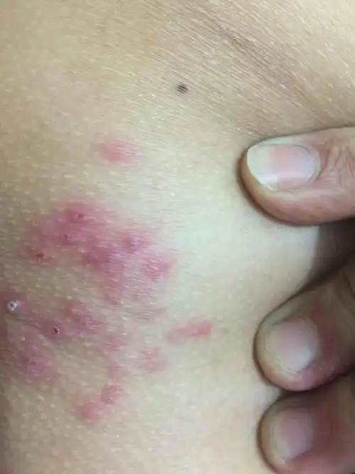 他臀部长疹子是什么