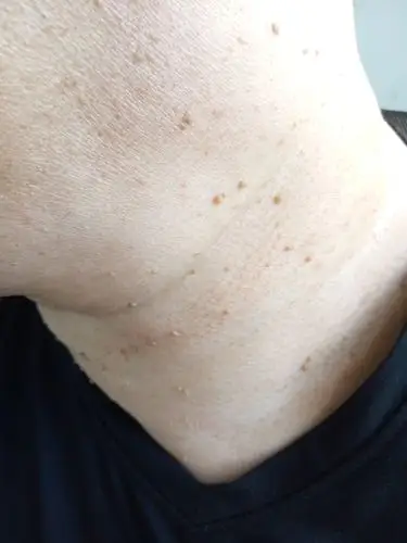 纤维瘤被保险公司拒保 纤维瘤被保险公司会赔