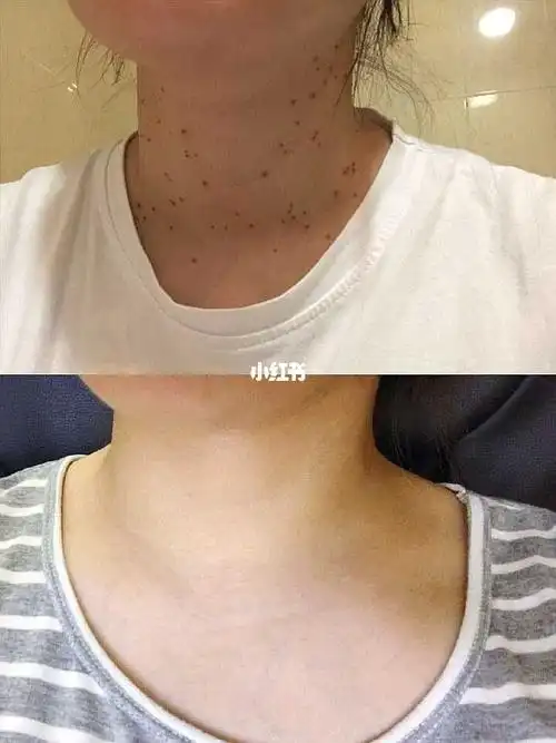 丝状疣不过是我的手下败将治愈还是很简单