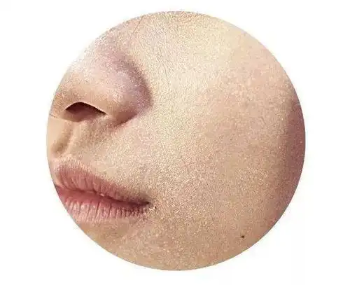 换季皮肤干痒?肌肤缺水给你的暗示!这几大表现,你中招了几个?