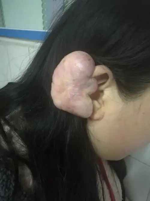 耳廓疤痕疙瘩的治疗 - 好大夫在线