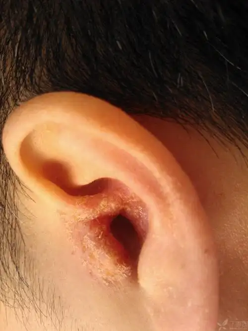 【求助】左耳廓内则破溃后,皮肤瘙痒,反复不愈 [病例帖]