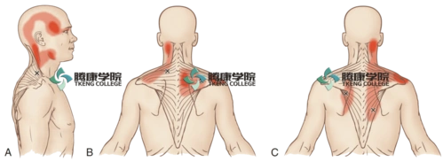 斜方肌的扳机点是引起头部和颈部疼痛的主要因素.