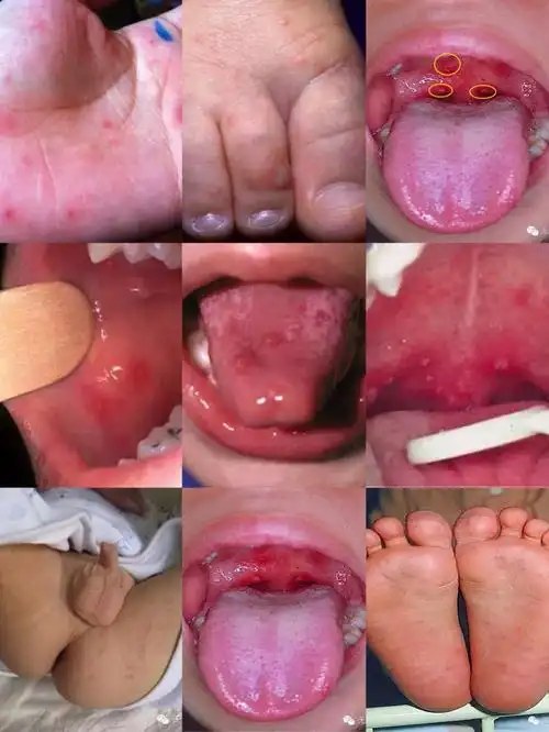 手足口病简介.高发季节如何预防?