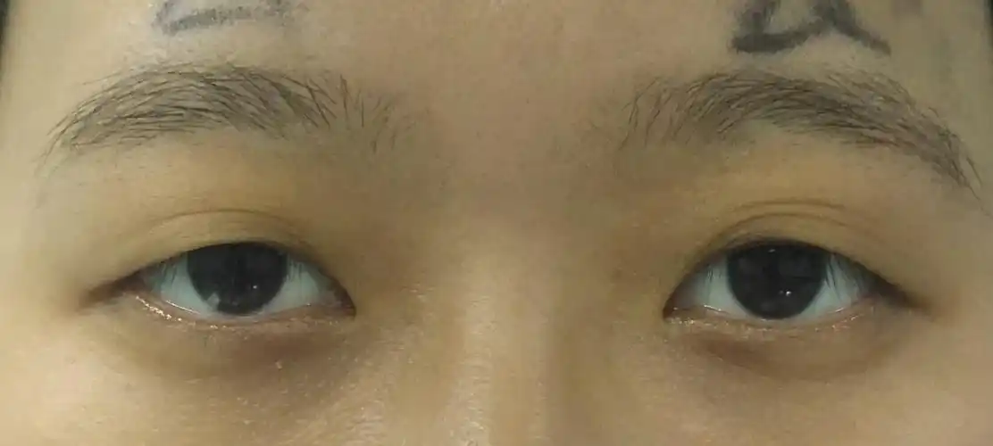 效果的效果,四十岁以后眉尾开始慢慢下垂,所以眼部老化趋于恶化!