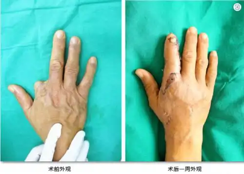 佛山顺德和平医院手指再造术圆你手指再生梦