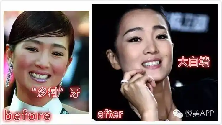 你是地包天都以为明星好当原来偷偷做了截骨术