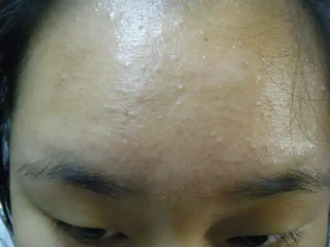 脸上长了封闭性闭口粉刺怎么办