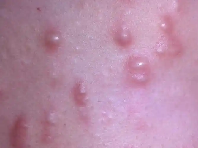 长了好多小包,平时不痛不痒,出汗了偶尔会痒,想知道这是什么皮肤病?